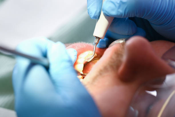Best Emergency Tooth Extraction in Pawtucket, RI