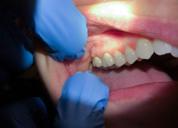 Best Emergency Treatment for Dental Infections or Abscesses in Pawtucket, RI